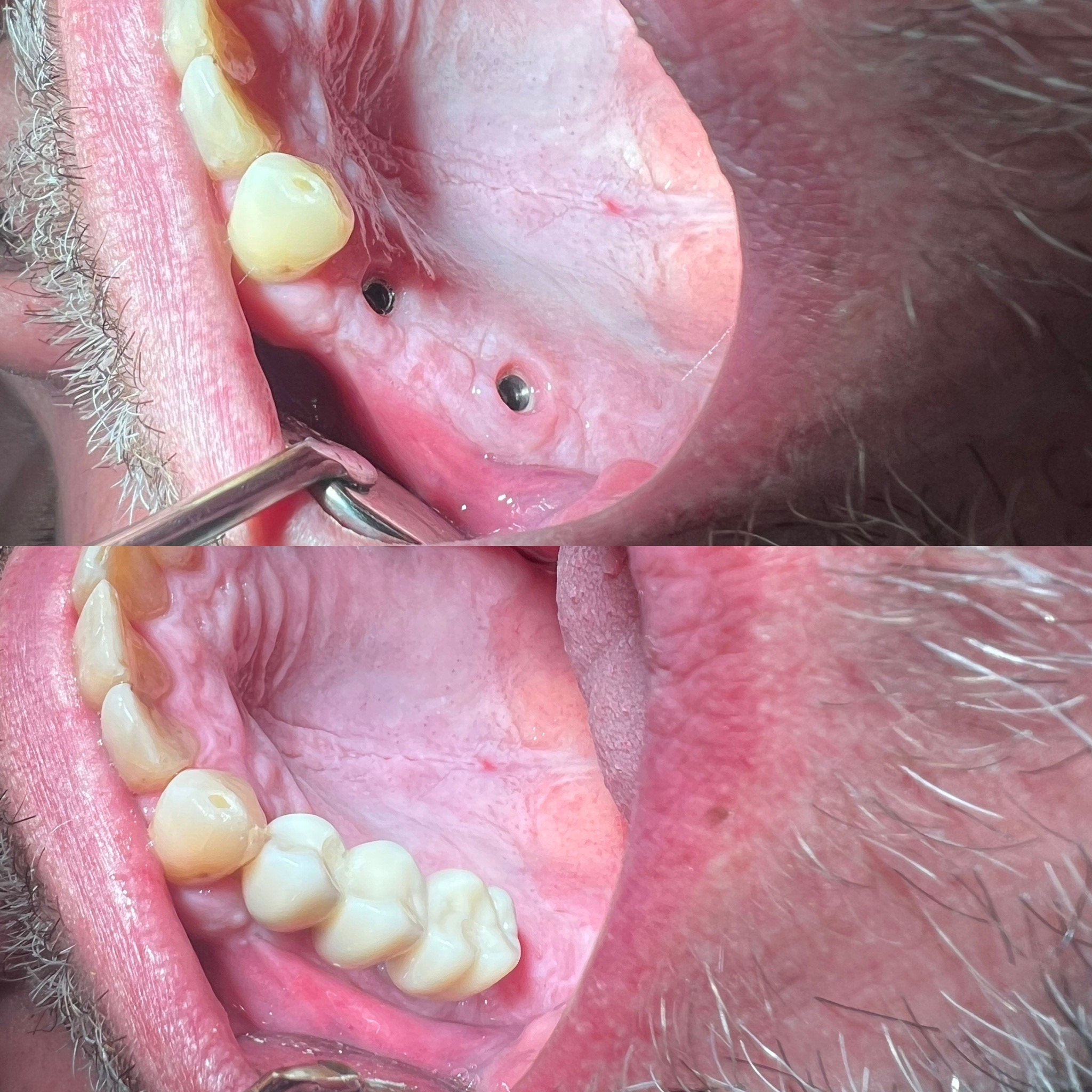 Implant Posterior Bridge